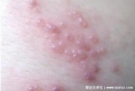 血热症状(仓鼠出血热症状)