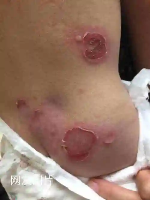 急性 接触性 传染性 皮肤病,由金黄色葡萄球菌引起,婴幼儿及儿童常见