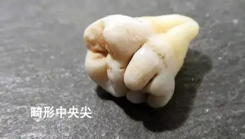 牙齿异常情况有哪些?_汕头口腔医疗中心