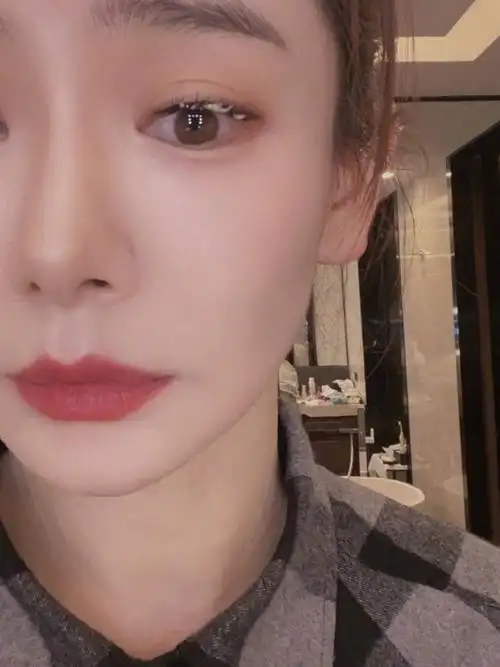 7815戚薇的双眼皮,做了很多年,仍然是痕迹比较明显的_圈子-新氧