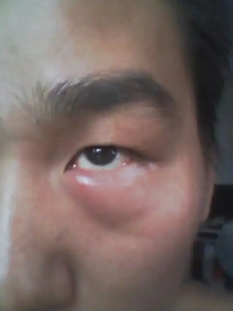 昨天有一点今天肿很大!