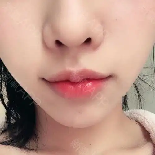 厚唇改薄好不好_效果图_耿琬凝sd厚唇改薄术后第63天_新氧美容整形