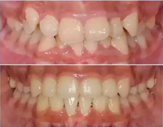 虎牙矫正前后对比图