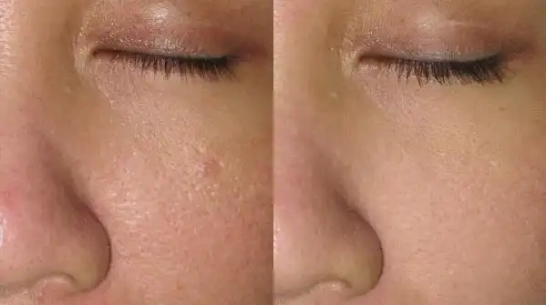 四,毛孔粗大治疗案例