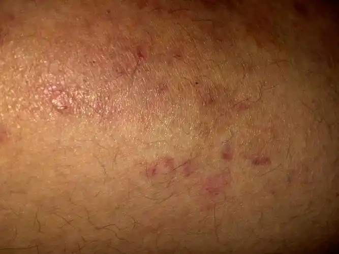 大家看看这是湿疹还是干燥性皮炎?