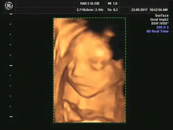 做四维看男孩女孩诀窍,如何通过四维照片上的