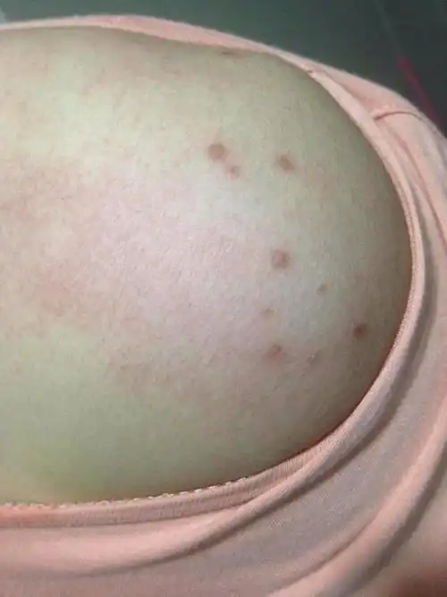 皮肤科专业学员!艾滋病专家!这个只有你们能看懂啊!