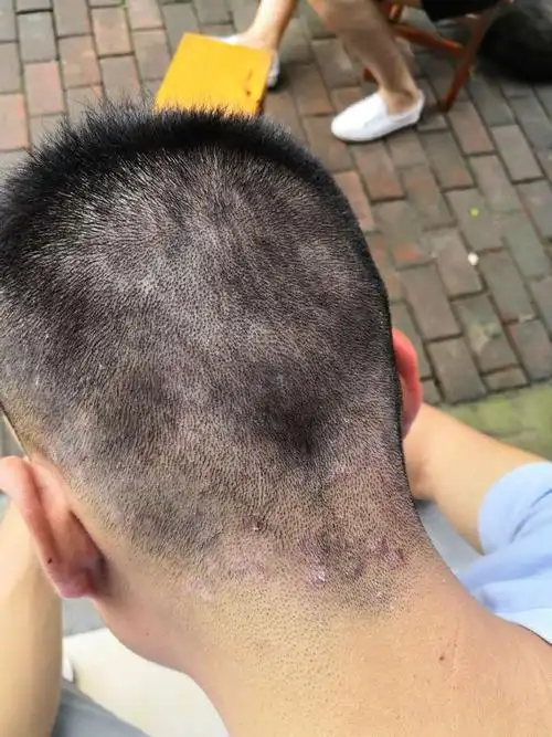 头皮上有头皮屑,这是什么情况,什么皮肤病