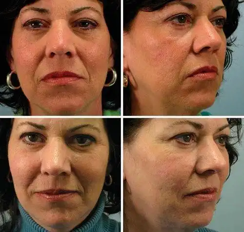 术前术后对比照.   22个月随访,未见面颊萎缩和下垂改善.