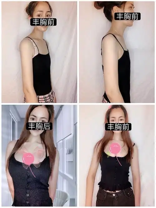 【自体脂肪形体雕塑】隆胸 ,【自体脂肪形体雕塑】隆胸 ,kibm大韩美容