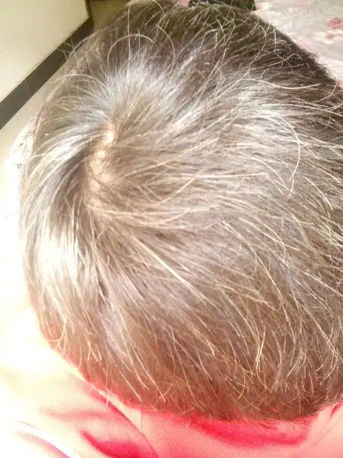 父亲45岁也已经满头白发,两位堂哥听说也有过此症状,到底是哪里出问