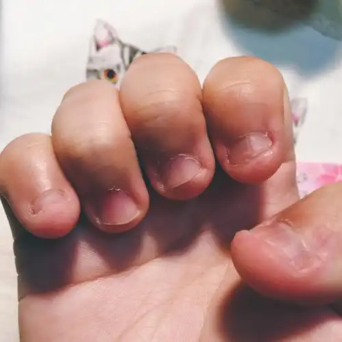 咬指甲怎么戒除? - 知乎