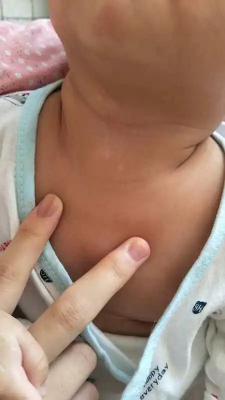 两个月的宝宝脖子下面长的这是什么?