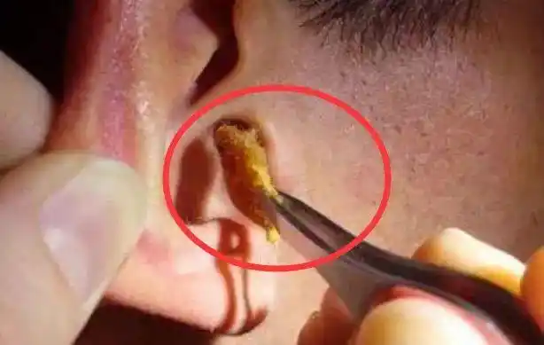 使耳朵充满粘性物质而不是干燥,甚至有些粘性物质也会流出耳朵,形成油