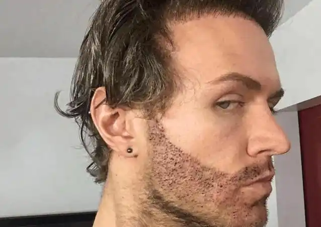 男子因胡子稀疏不自信,花9000英镑移植,最后都称帅呆了