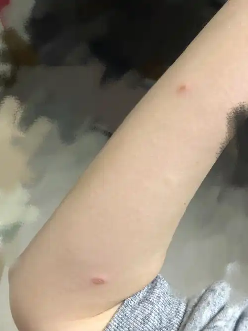 【讨论】大家帮我看看这是被跳蚤咬的包吗?