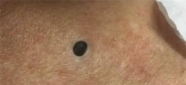 许多人自从青春期之后,黑头粉刺便常驻在鼻头上,怎麼也用不掉.