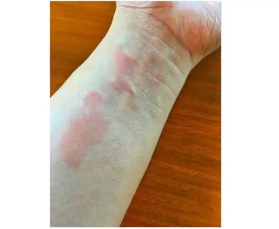 有这么三种皮肤病大多数人都得过