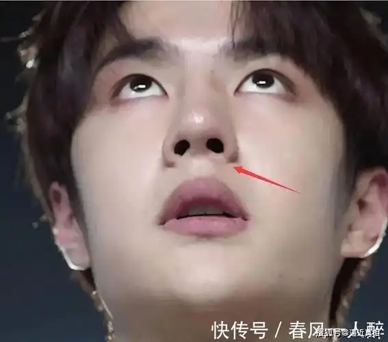 王一博疑似整容失败鼻梁乌青发黑被质疑刚取了假体
