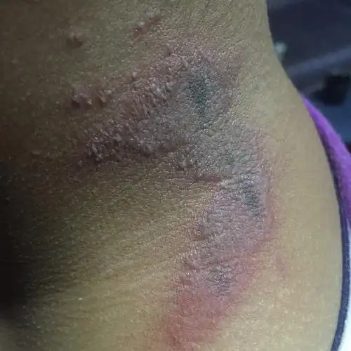 脖子后长了一片红红的有水泡,麻麻的碰了会痛但不痒,是什么?用什么