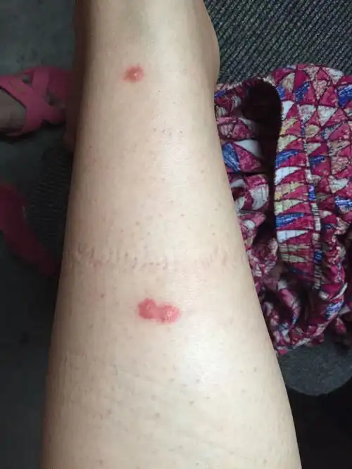 跳蚤咬的症状图片(怎么判断是被跳蚤咬的)