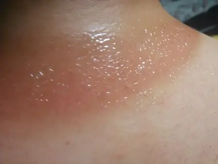 太阳晒伤成如图症状如何处理