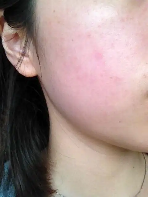 女子抹面霜竟起满脸红斑:不洗手造成化妆品污染