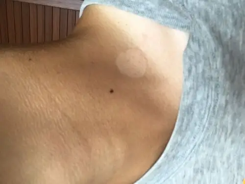 脖子上长了一块圆形的 呈白色的像癣,不知道是不是