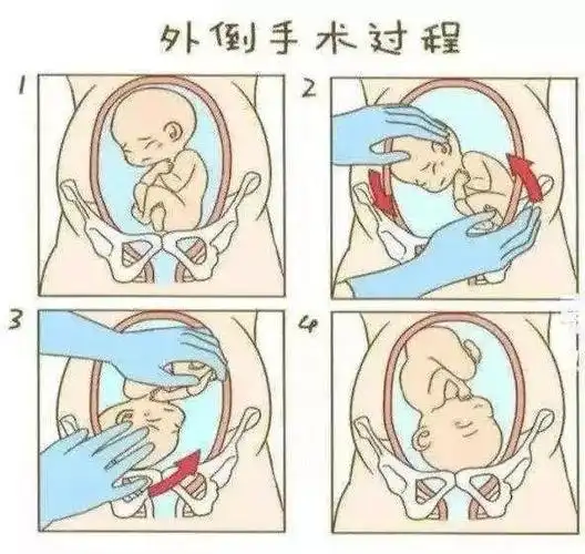 臀位外倒转术,可以纠正胎儿胎位,有利于顺产,降低阴道分娩并发症.