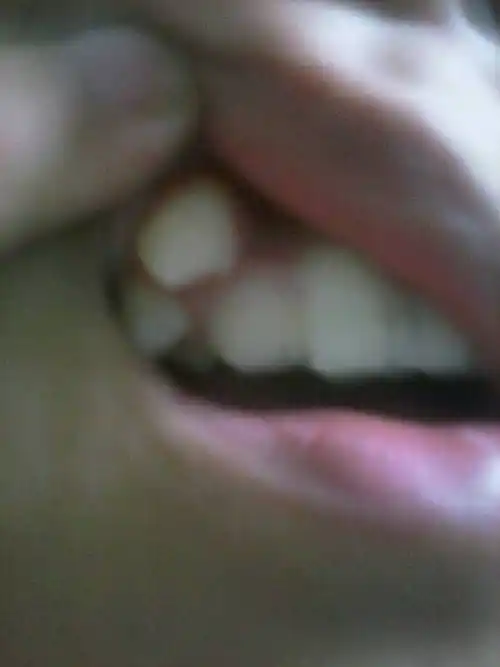 我虎牙长到牙龈上了.