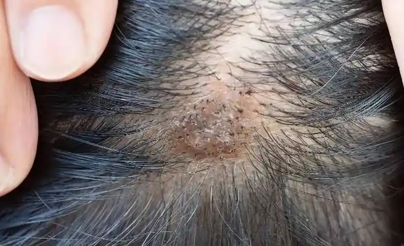 毛囊炎患者脱落下来的结痂,如果不慎直接接触的话,也会诱发间接性感染