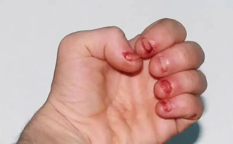 孩子总啃指甲怎么办?小习惯别拖成大问题