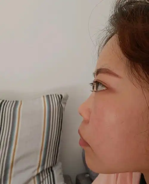 朝天鼻塌鼻子要做那种材料