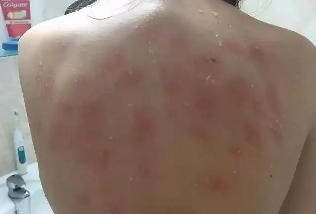 世界最"惨"过敏症:一喝水就浑身红肿,不喝水就心跳过速