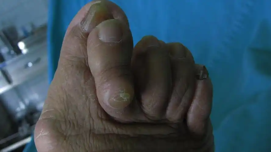 踇外翻叠趾畸形 术前术后 对照图