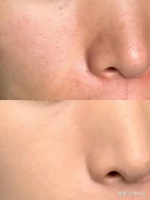 男生毛孔粗大,黑头多,出油长痘怎么办?