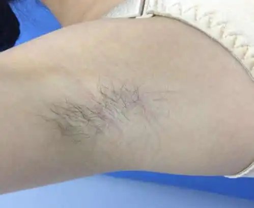 用镊子拔腋毛经常拔腋毛有什么坏处组图