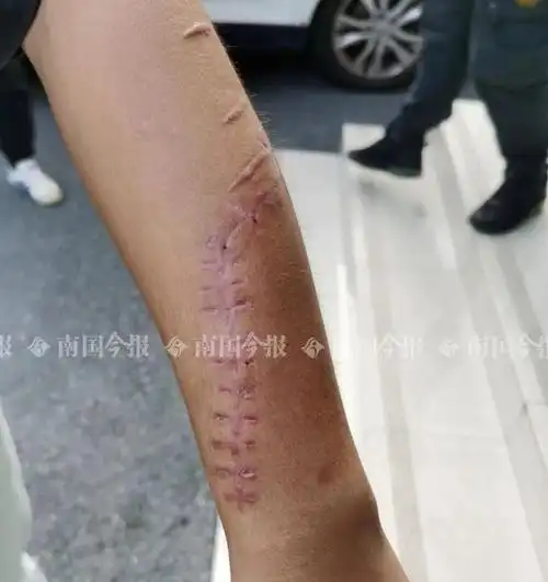 有人偷电车电瓶广西一外卖小哥追贼被砍伤伤口深可见骨