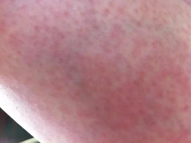 全身起了红疙瘩怎么办?