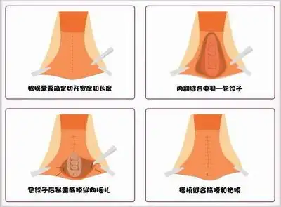 桥式阴道紧缩术 vaginal tightening surgery