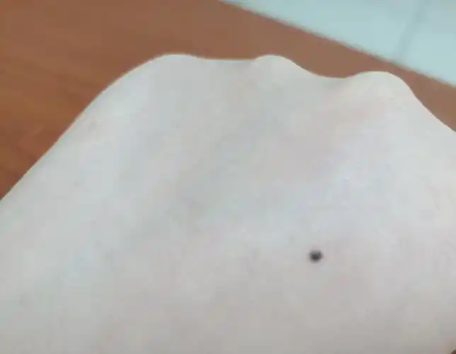 手背上的痣变得更黑了,还有点凸起来,要不要去看一下呀?