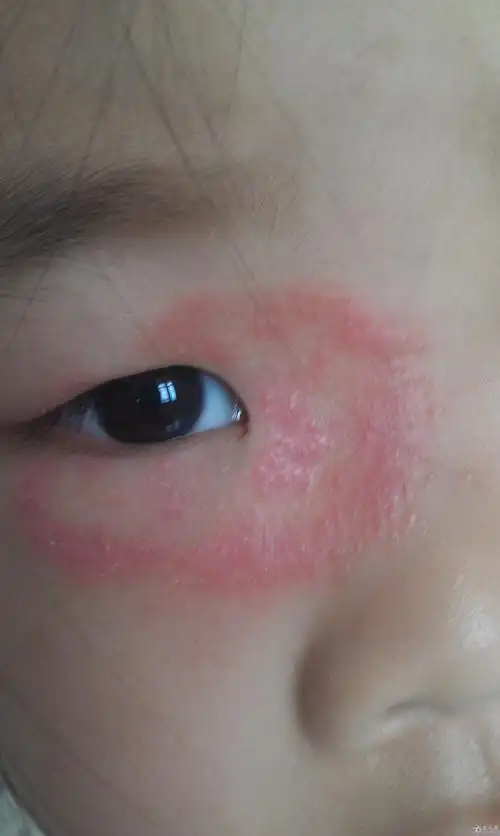 救急这个是真菌感染还是过敏性皮炎谢谢