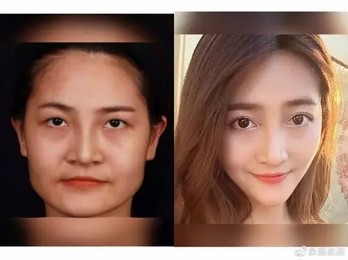 整容后,现在每天都很开心!