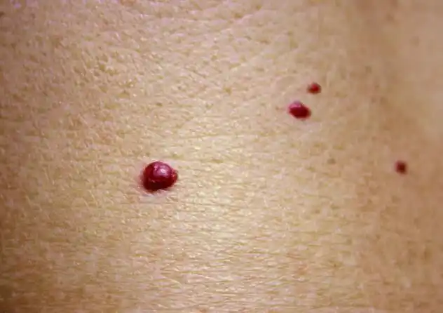 红痣与朱砂痣区别图片(红痣与朱砂痣是什么意思)