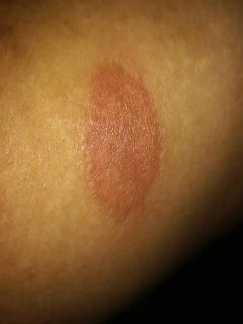 大腿和颈部莫名其妙多了两个斑块,表面有些粗糙,有时轻微痒有时疼