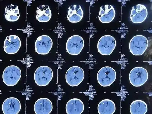 图19:2015-4-19 ct:脑室系统正常