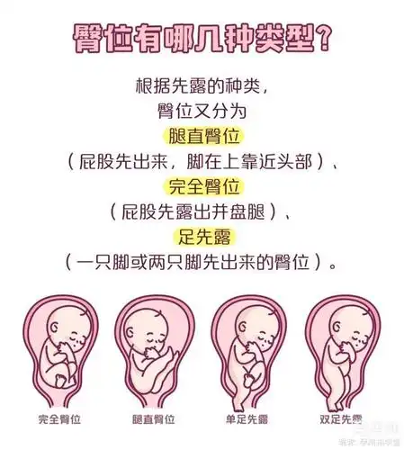 遇到臀位宝宝,如何避免挨一刀?