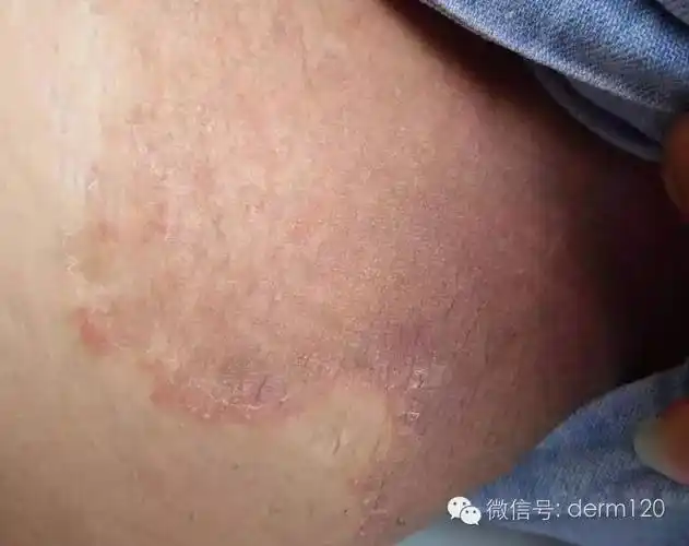 大腿根容易潮湿红肿瘙痒脱皮怎么办呢