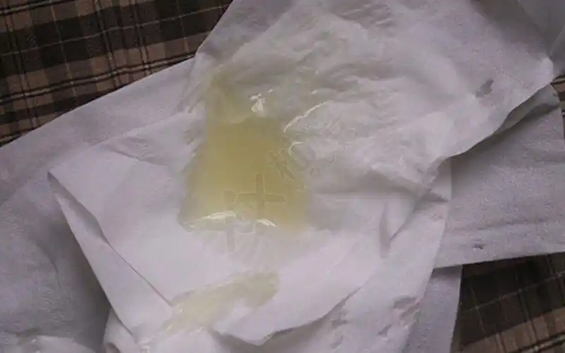 1死精症精子什么颜色