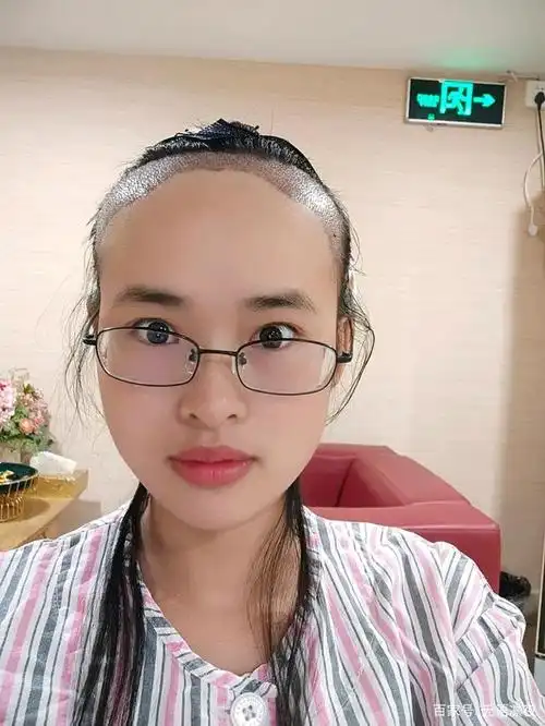 超详细中年秃头少女植发记